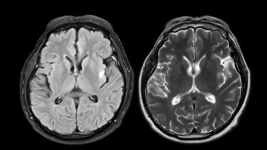 MRI brain scan axial T1W for detect Brain diseases sush as stroke disease, Brain tumors and Infections.