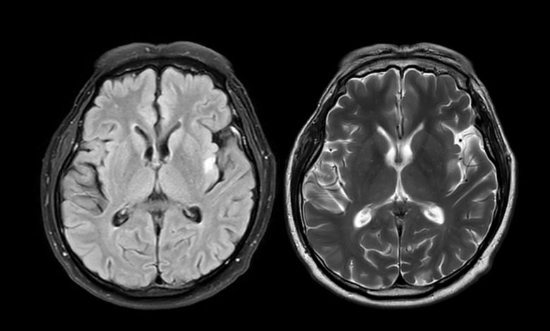 MRI brain scan axial T1W for detect Brain diseases sush as stroke disease, Brain tumors and Infections.